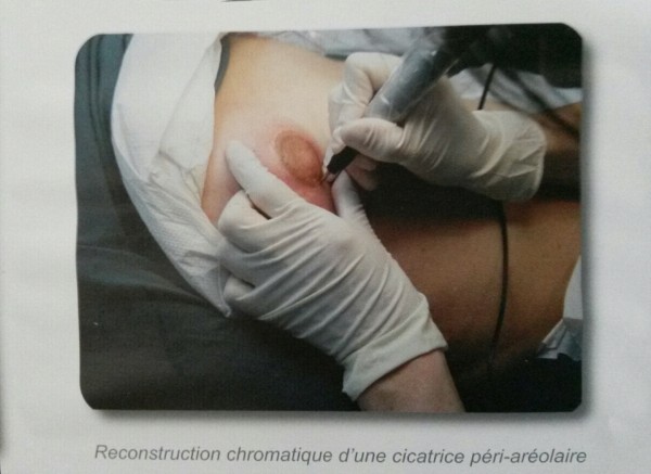 Dermographie pigmentation du mamelon 'aréole de sein' (Cancer du sein après chirurgie).<br />

