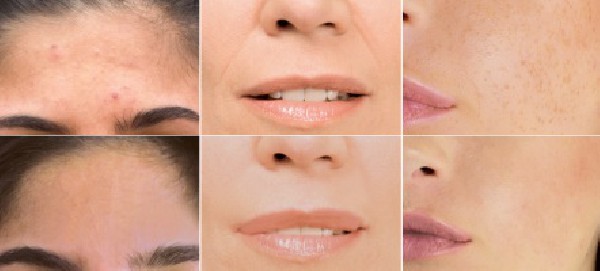 LA PHOTOTHERAPIE EN 10 SEANCES (rajeunissement cellulaire-acné-tâches pigmentaires -cellulite et vergetures)